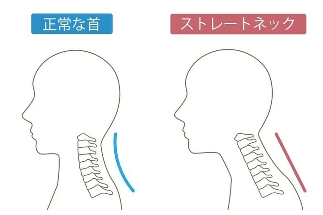 スマホ首（ストレートネック）は危険？原因と1分改善法｜上越市...